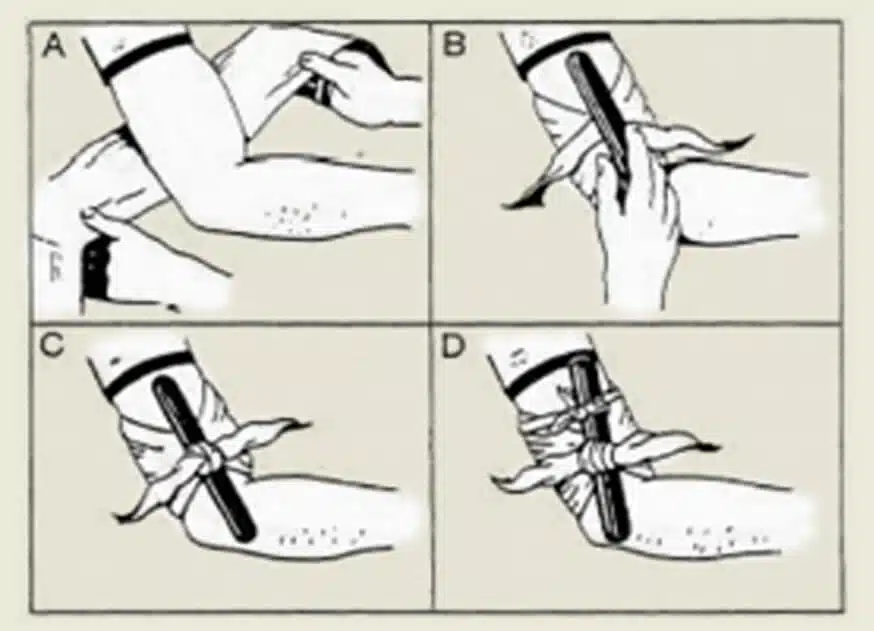 bron crises-medicine.com geimproviseerd windwill tourniquet